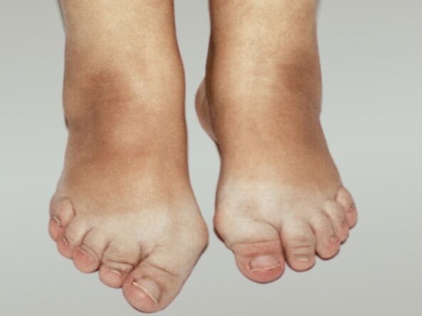 Osteoartrita piciorului cu deformare severă a degetelor de la picioare