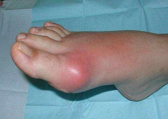 Tabloul clinic al artritei piciorului - umflare și inflamație