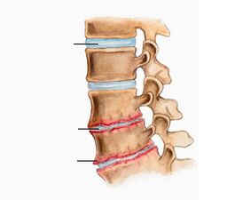 Osteochondroză