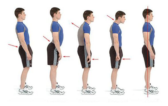 Prevenirea osteochondrozei