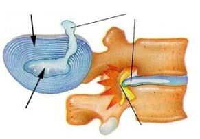 distrugerea inelului fibros în osteocondroza cervicală