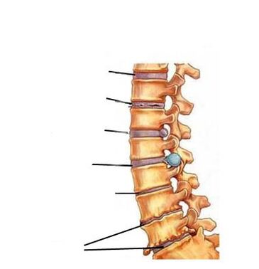 stadiile dezvoltării osteocondrozei