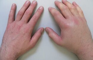 artralgia ca cauză a durerii în articulațiile degetelor
