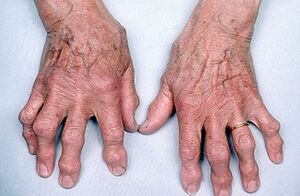 cum să scapi de durerea articulațiilor degetelor