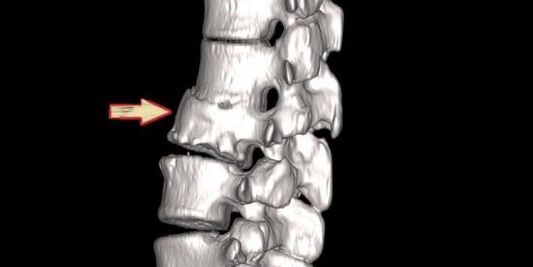 patologia coloanei vertebrale ca cauză a durerilor de spate