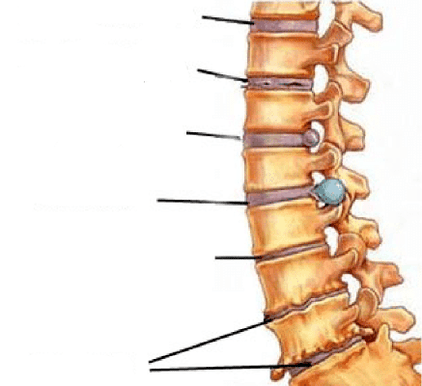 etapele de dezvoltare a osteocondrozei coloanei vertebrale
