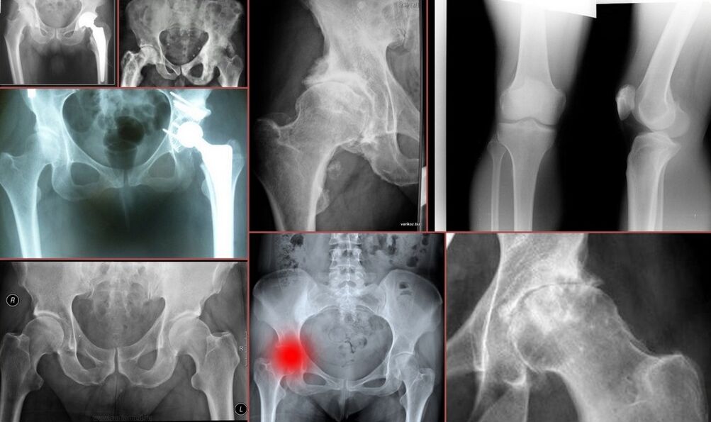 Radiografie pentru durerea de șold