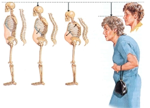 cum arată dureri de spate